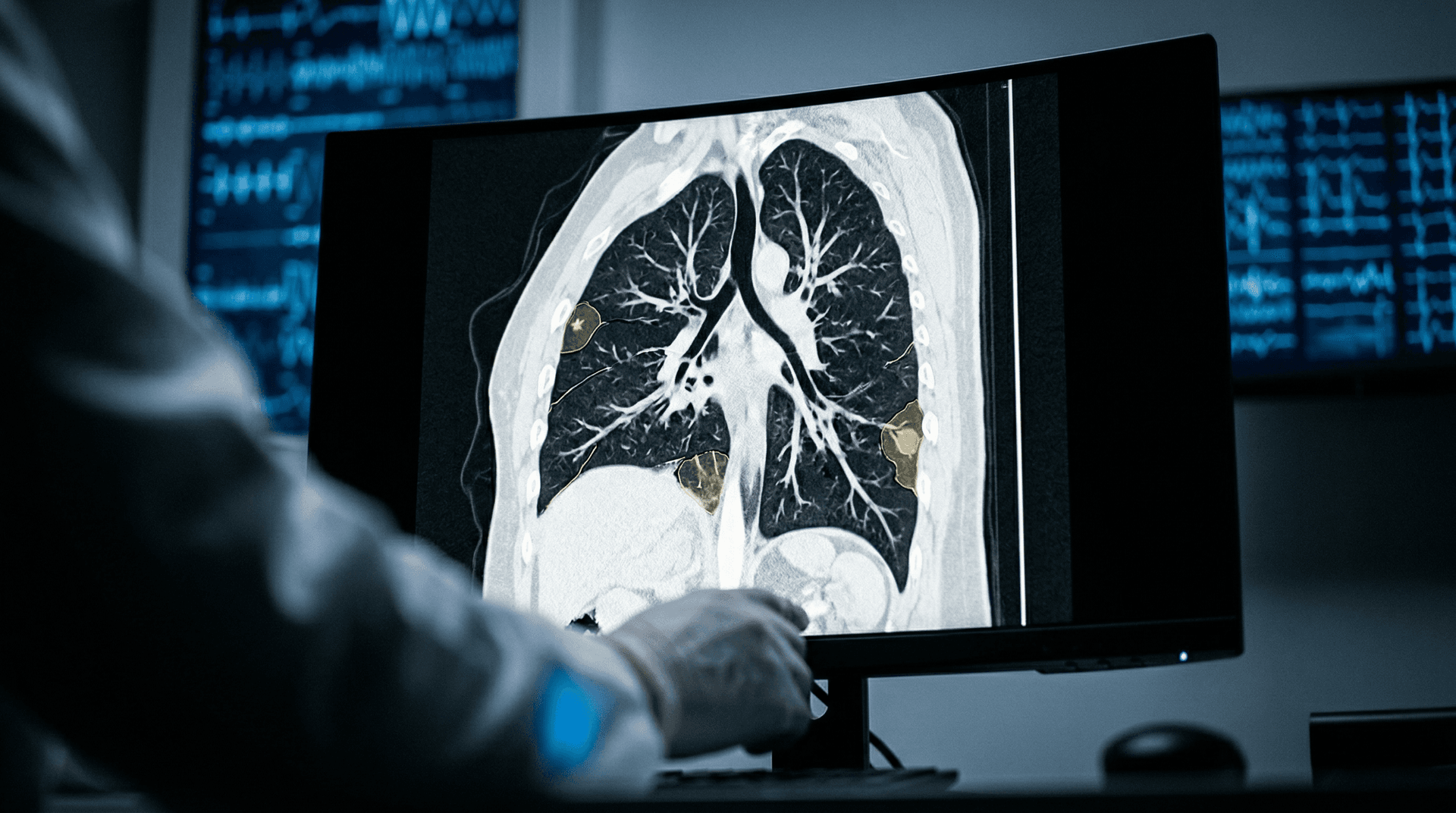 AI Low-Dose CT Lung Cancer Screening Cuts Radiation 80% in Cureus Study